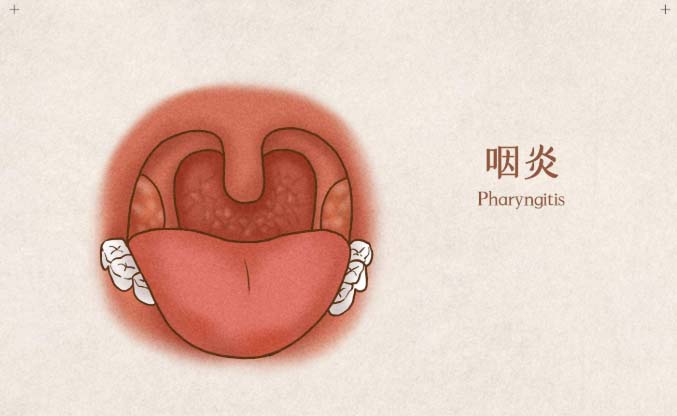 中醫(yī)解讀咽炎：從認(rèn)知到防