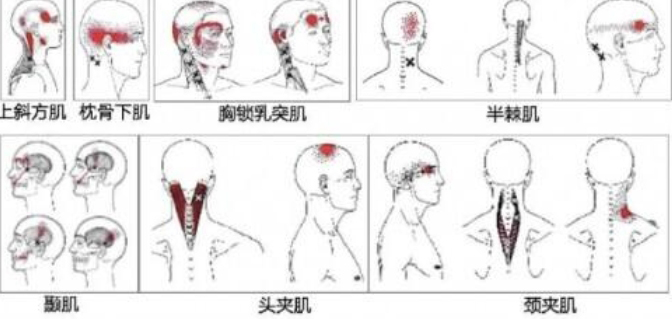 頭痛：探尋病因與應(yīng)對之道